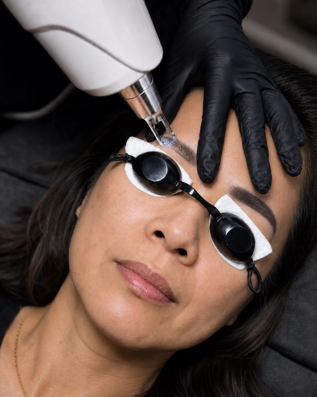 Tattoo Removal